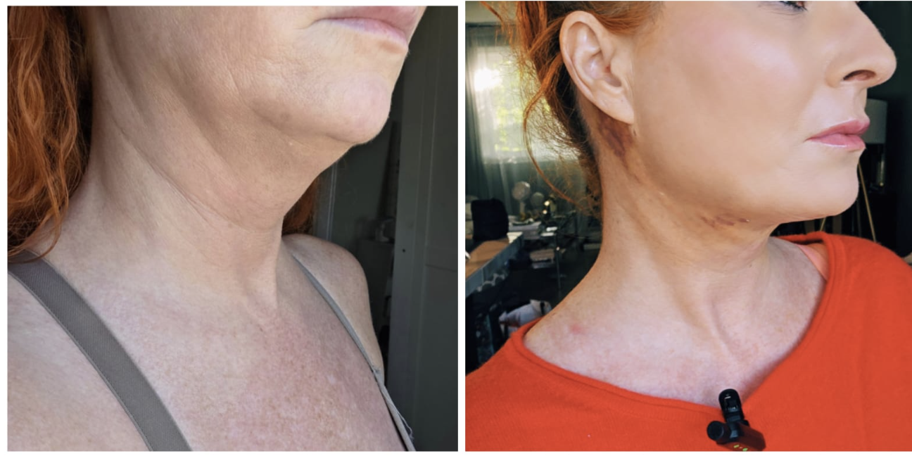 Photo avant et après — Liposuccion du menton